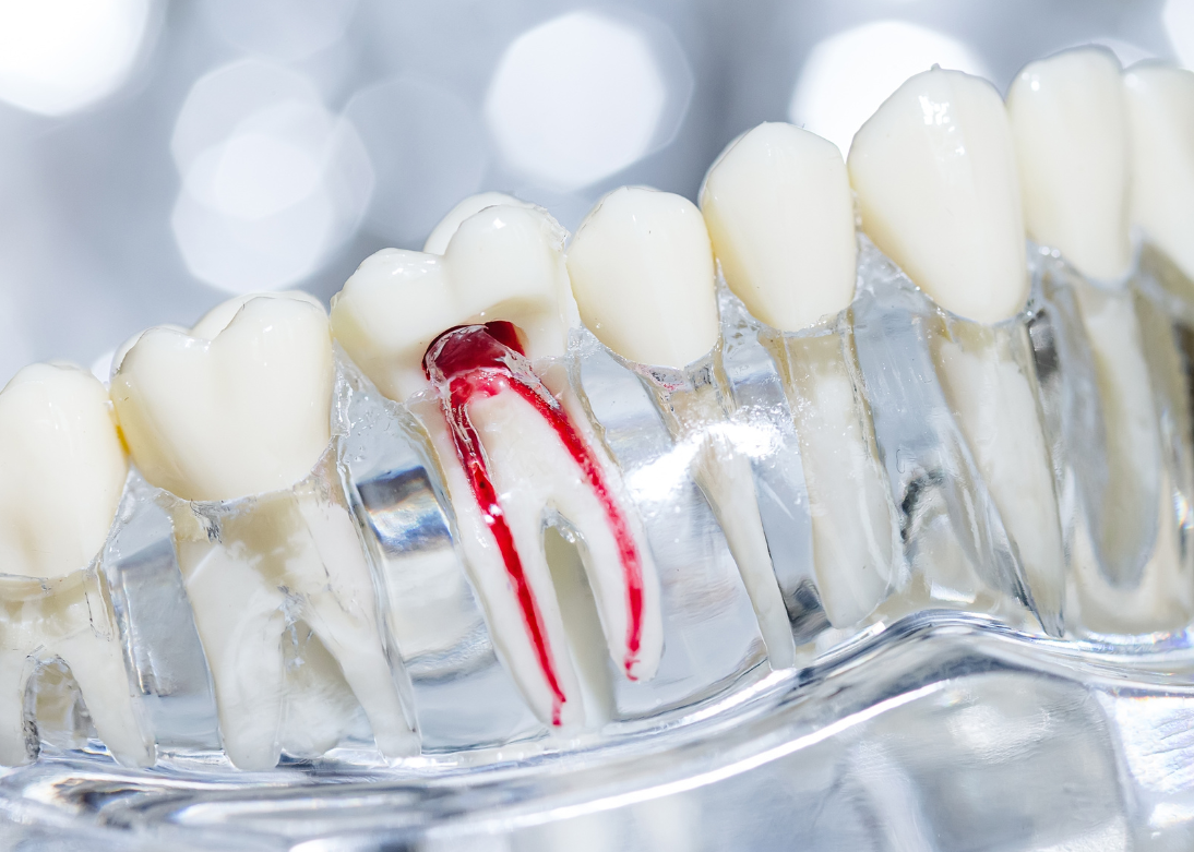 Painless Root Canal Treatment